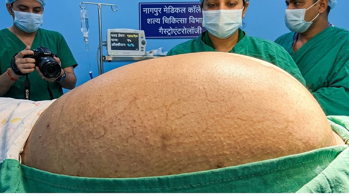 सातारा की महिला के पेट में तीन तरबूज जितना बड़ा ट्यूमर, करीब 3 घंटे चली जटिल सर्जरी