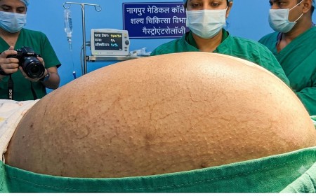 सातारा की महिला के पेट में तीन तरबूज जितना बड़ा ट्यूमर, करीब 3 घंटे चली जटिल सर्जरी